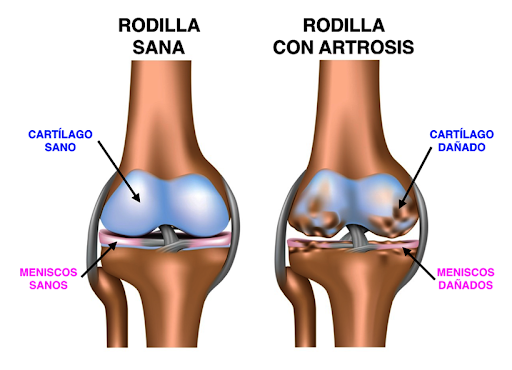 Artrosis de rodilla y su tratamiento mediante la fisioterapia