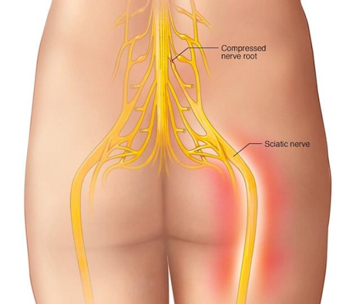 Ciática y su intervención mediante la fisioterapia