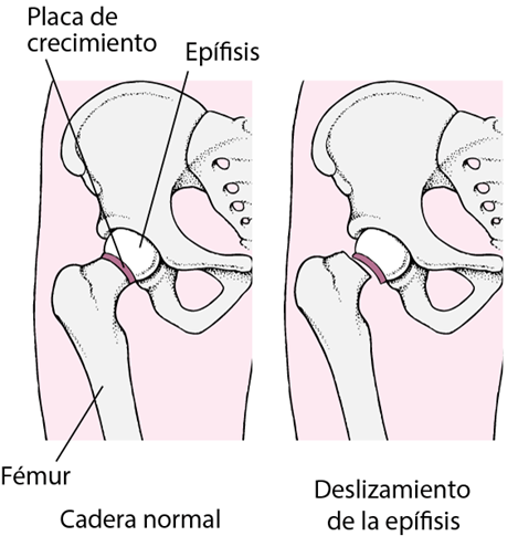 Diagnóstico y tratamiento para el dolor de cadera en adolescentes.