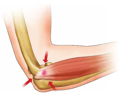 La epicondilitis lateral o codo de tenista