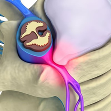 Radiculopatía cervical producida por una hernia discal