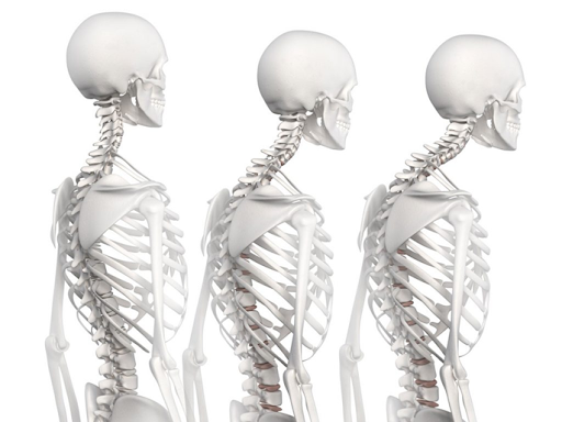 Hipercifosis por osteoporosis: ¿Qué es y cuál es su tratamiento?