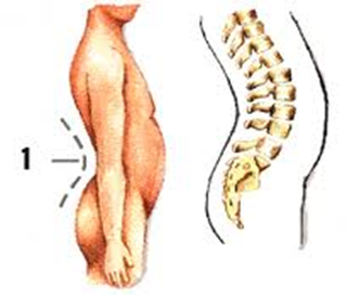 Hiperlordosis lumbar: Tratamiento a través de la fisioterapia