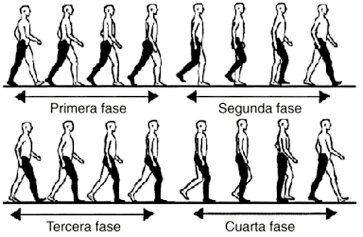 Dolor de pie y alteraciones de la marcha asociados al uso de tacones.