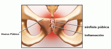 ¿Qué es la osteopatia dinámica del pubis?
