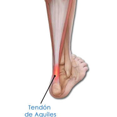 ¿Qué es la tendinitis de aquiles?