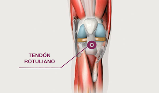 Tendinitis Rotuliana: Masaje Transverso Profundo como tratamiento.