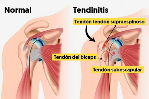 Tendinitis Supraespinoso