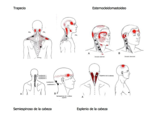 Tratamiento mediante Fisioterapia para la Cefalea Tensional