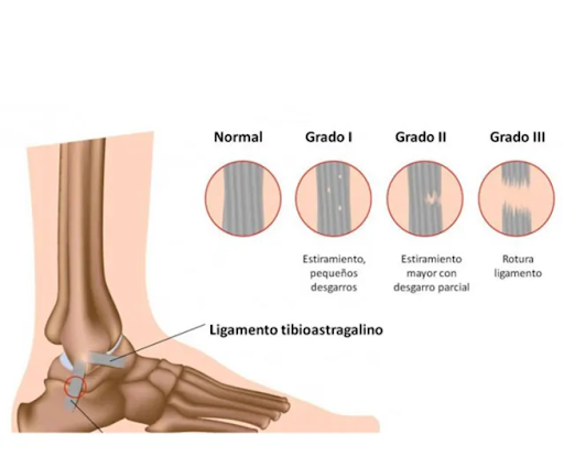 Esguince de tobillo: Anatomía, clasificación y tratamiento.