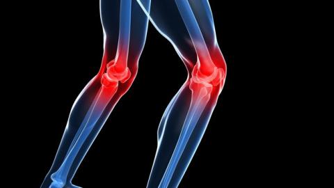 Artrosis de rodilla y su tratamiento mediante la fisioterapia
