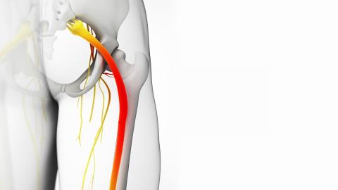 Ciática y su intervención mediante la fisioterapia Ciática y su intervención mediante la fisioterapia
