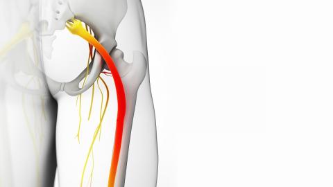 Ciática y su intervención mediante la fisioterapia