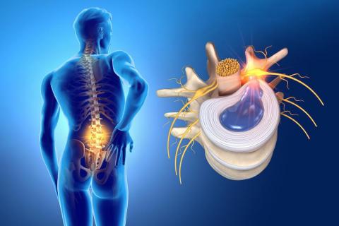 ¿Qué es una hernia discal lumbar? Diagnóstico y Tratamiento ¿Qué es una hernia discal lumbar? Diagnóstico y Tratamiento
