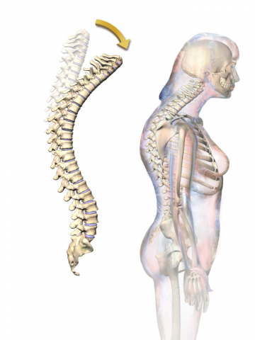 Hipercifosis por osteoporosis: ¿Qué es y cuál es su tratamiento?