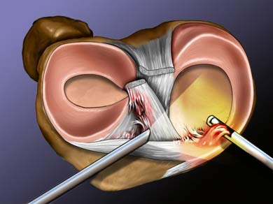 ¿Qué es la meniscectomía y cuál es su tratamiento mediante la fisioterapia?