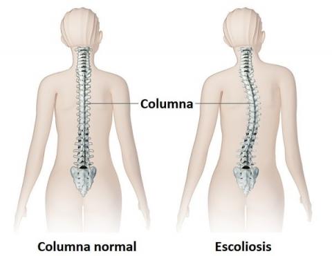 ¿Qué papel desempeña la fisioterapia en el tratamiento de la escoliosis? ¿Qué papel desempeña la fisioterapia en el tratamiento de la escoliosis?