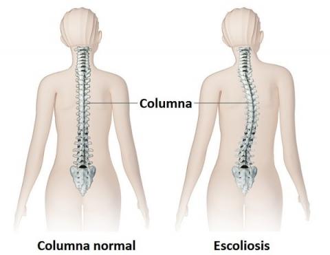 ¿Qué papel desempeña la fisioterapia en el tratamiento de la escoliosis?