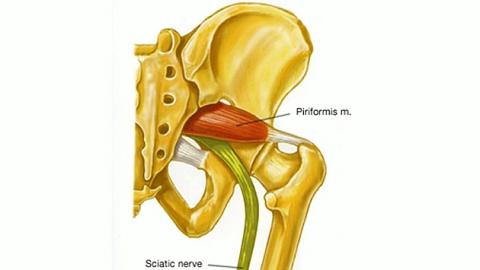 Tratamiento mediante la Fisioterapia para el Síndrome del Músculo Piramidal