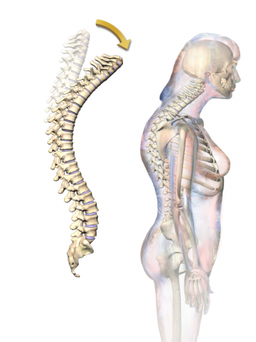 Hipercifosis por osteoporosis: ¿Qué es y cuál es su tratamiento? Hipercifosis por osteoporosis: ¿Qué es y cuál es su tratamiento?