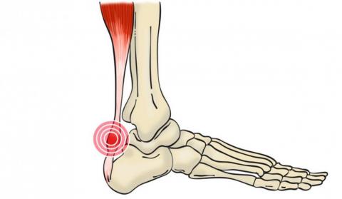 Abordaje desde la fisioterapia para la tendinitis aquilea Abordaje desde la fisioterapia para la tendinitis aquilea