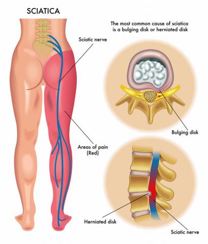 Protocolo de tratamiento para la ciática mediante la fisioterapia Protocolo de tratamiento para la ciática mediante la fisioterapia