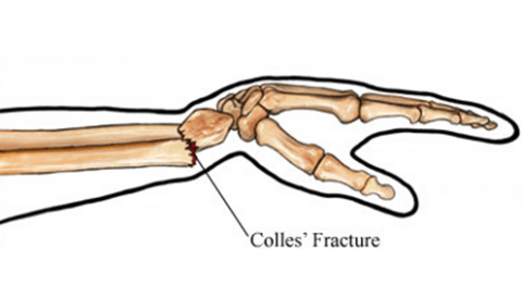 Tratamiento fisioterapéutico de la fractura de colles Tratamiento fisioterapéutico de la fractura de colles