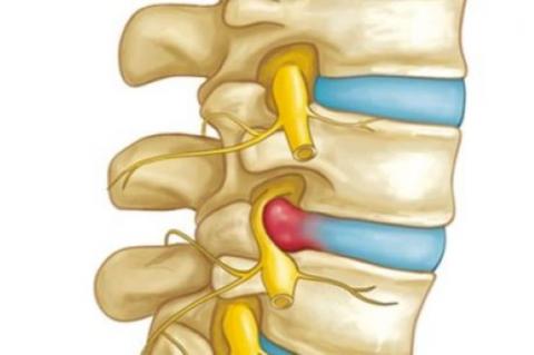 Protocolo de tratamiento para la hernia discal lumbar mediante la fisioterapia