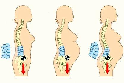 Tratamiento fisioterapéutico para corregir la hiperlordosis lumbar Tratamiento fisioterapéutico para corregir la hiperlordosis lumbar