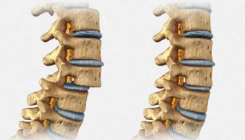 ¿Cómo disminuir el dolor lumbar producido por la inestabilidad de la columna?