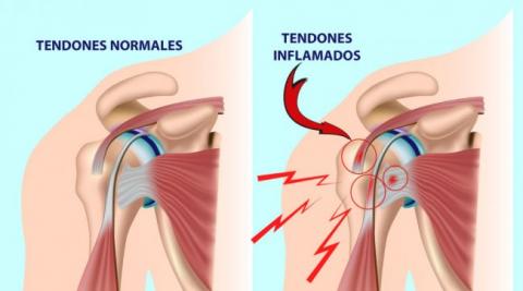 ¿Cómo tratar la lesión del manguito rotador desde la fisioterapia?