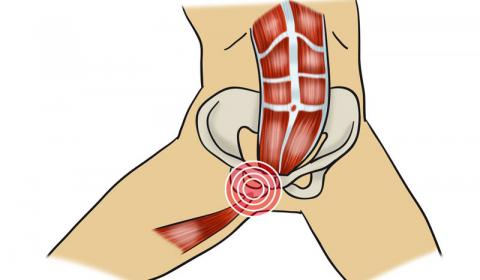 Osteopatía dinámica de pubis y su tratamiento fisioterapéutico Osteopatía dinámica de pubis y su tratamiento fisioterapéutico