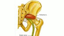 Tratamiento mediante la Fisioterapia para el Síndrome del Músculo Piramidal