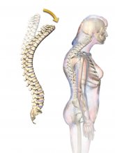 Hipercifosis por osteoporosis: ¿Qué es y cuál es su tratamiento?