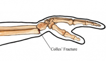 Tratamiento fisioterapéutico de la fractura de colles