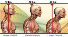 ¿Cómo corregir las posturas hipercifoticas mediante la fisioterapia?