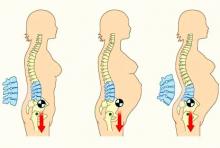 Tratamiento fisioterapéutico para corregir la hiperlordosis lumbar