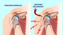 ¿Cómo tratar la lesión del manguito rotador desde la fisioterapia?