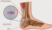 Tratamiento fisioterapéutico con láser en la Tendinitis aquilea