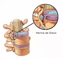 ¿Cómo tratar la hernia discal cervical desde la fisioterapia?